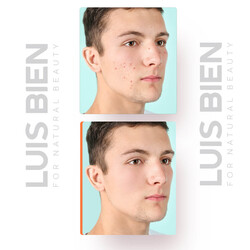 Anti Acne Care Cream - Luis Bien - 3